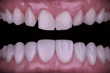 Desgaste y Pérdida Dentaria