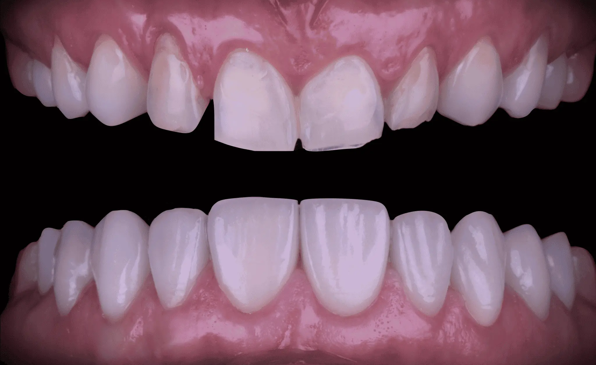 Desgaste y Pérdida Dentaria