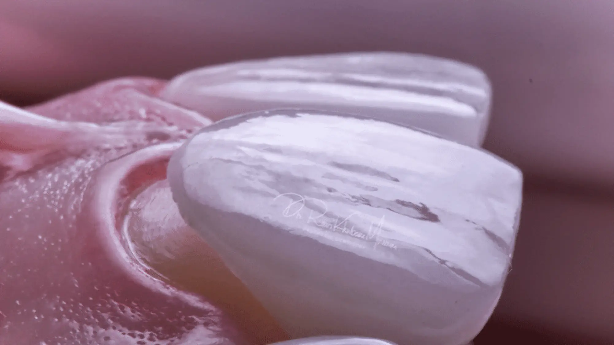 ¿Qué es el Diseño de Sonrisa?