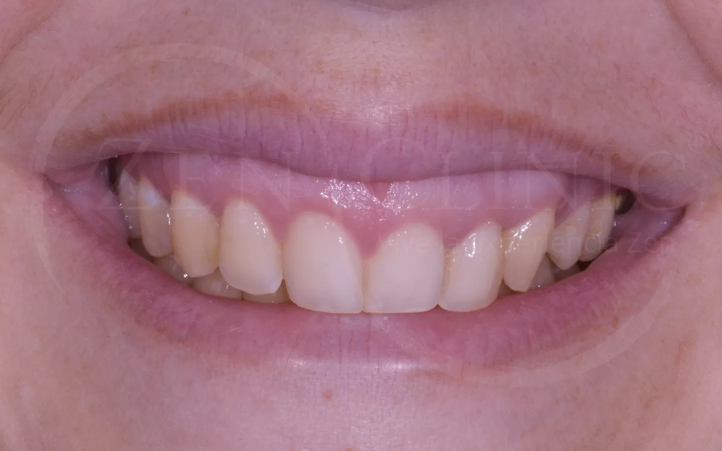 Caso de carillas cerámicas del Dr. Ravi Khubani en Zenclinic Dental (antes)
