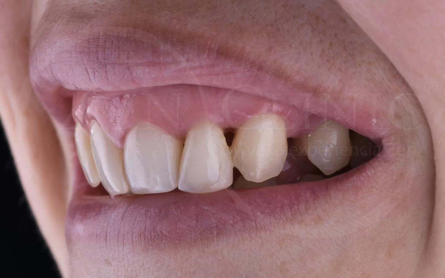 Caso de carillas cerámicas del Dr. Ravi Khubani en Zenclinic Dental (antes)