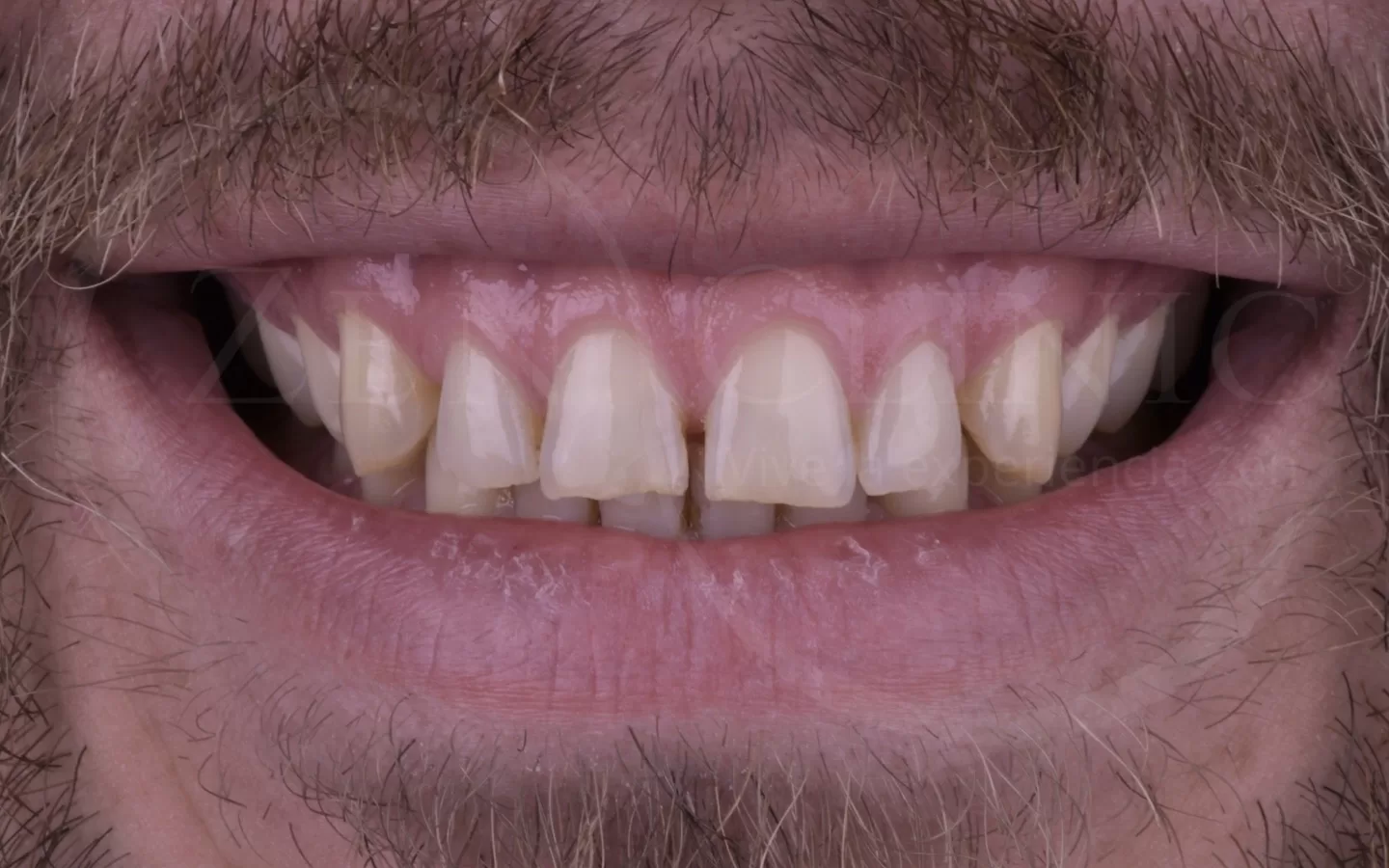Caso de carillas cerámicas del Dr. Ravi Khubani en Zenclinic Dental (antes)