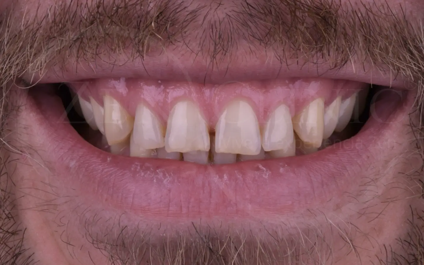 Antes