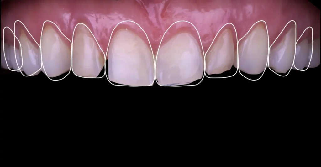 Planificación y diseño digital de sonrisa con software especializado