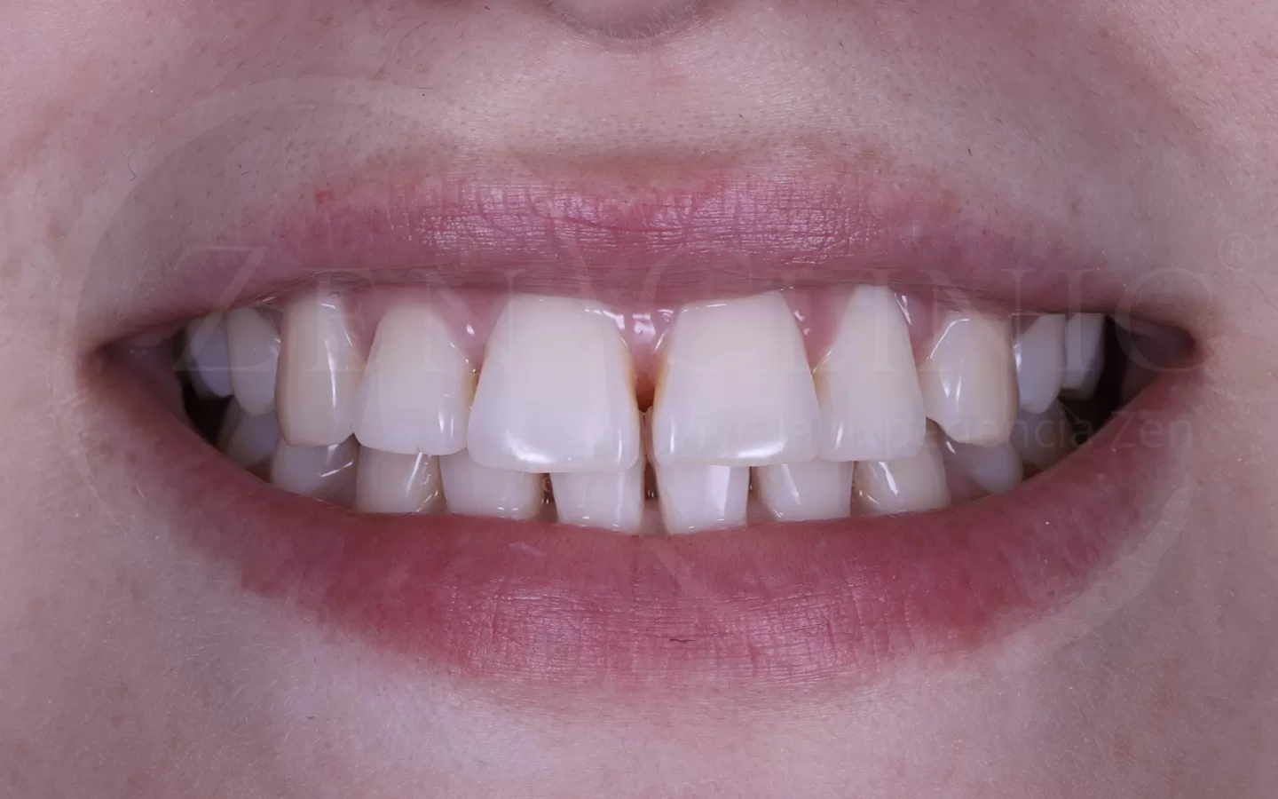 Caso de ortodoncia con Invisalign del Dr. Andrés Flores en Zenclinic Dental (antes)