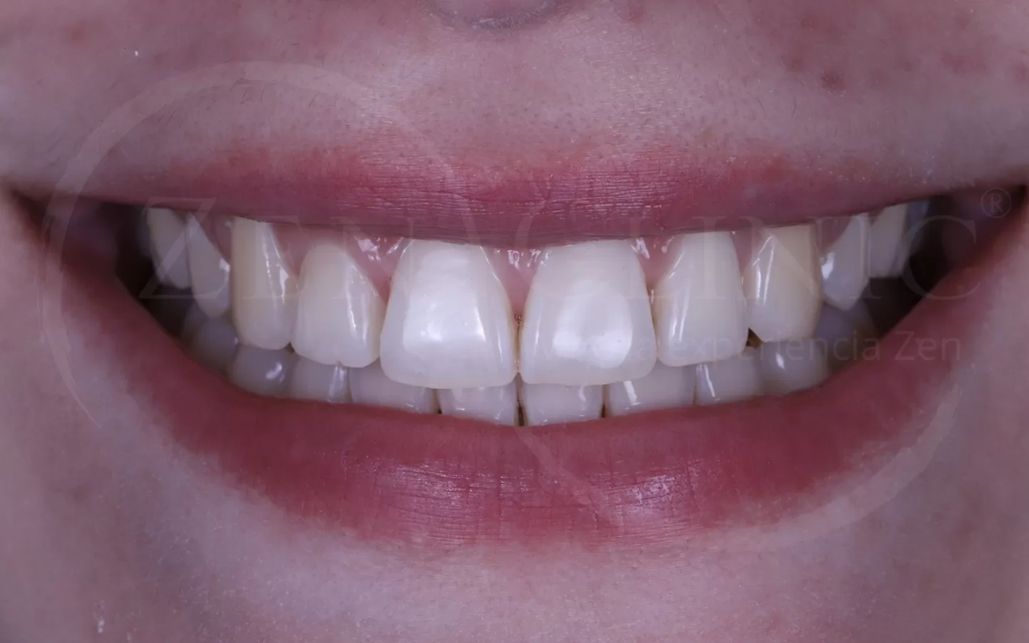 Caso de ortodoncia con Invisalign del Dr. Andrés Flores en Zenclinic Dental (después)