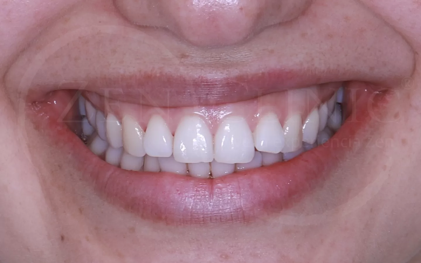 Caso de ortodoncia con Invisalign del Dr. Andrés Flores en Zenclinic Dental (antes)