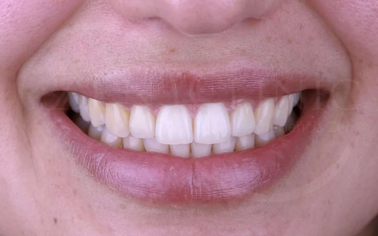 Caso de ortodoncia con Invisalign del Dr. Andrés Flores en Zenclinic Dental (después)