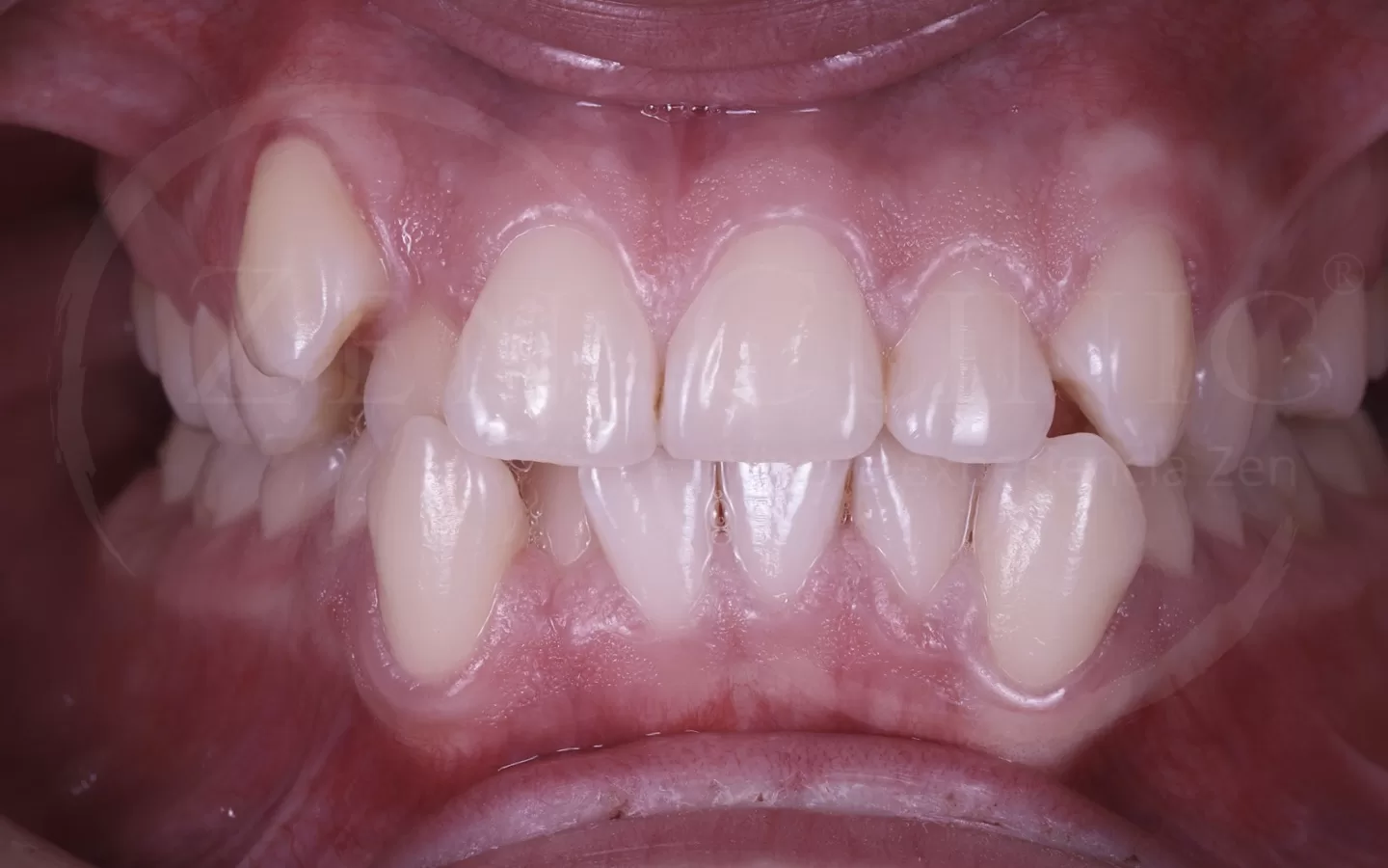 Caso de ortodoncia con Invisalign del Dr. Andrés Flores en Zenclinic Dental (antes)
