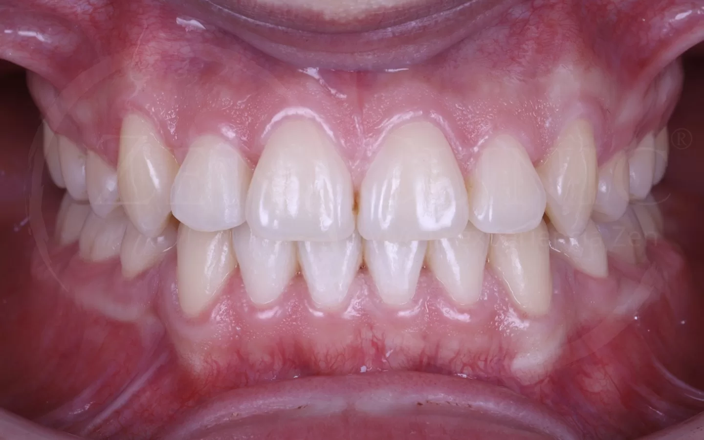 Caso de ortodoncia con Invisalign del Dr. Andrés Flores en Zenclinic Dental (después)