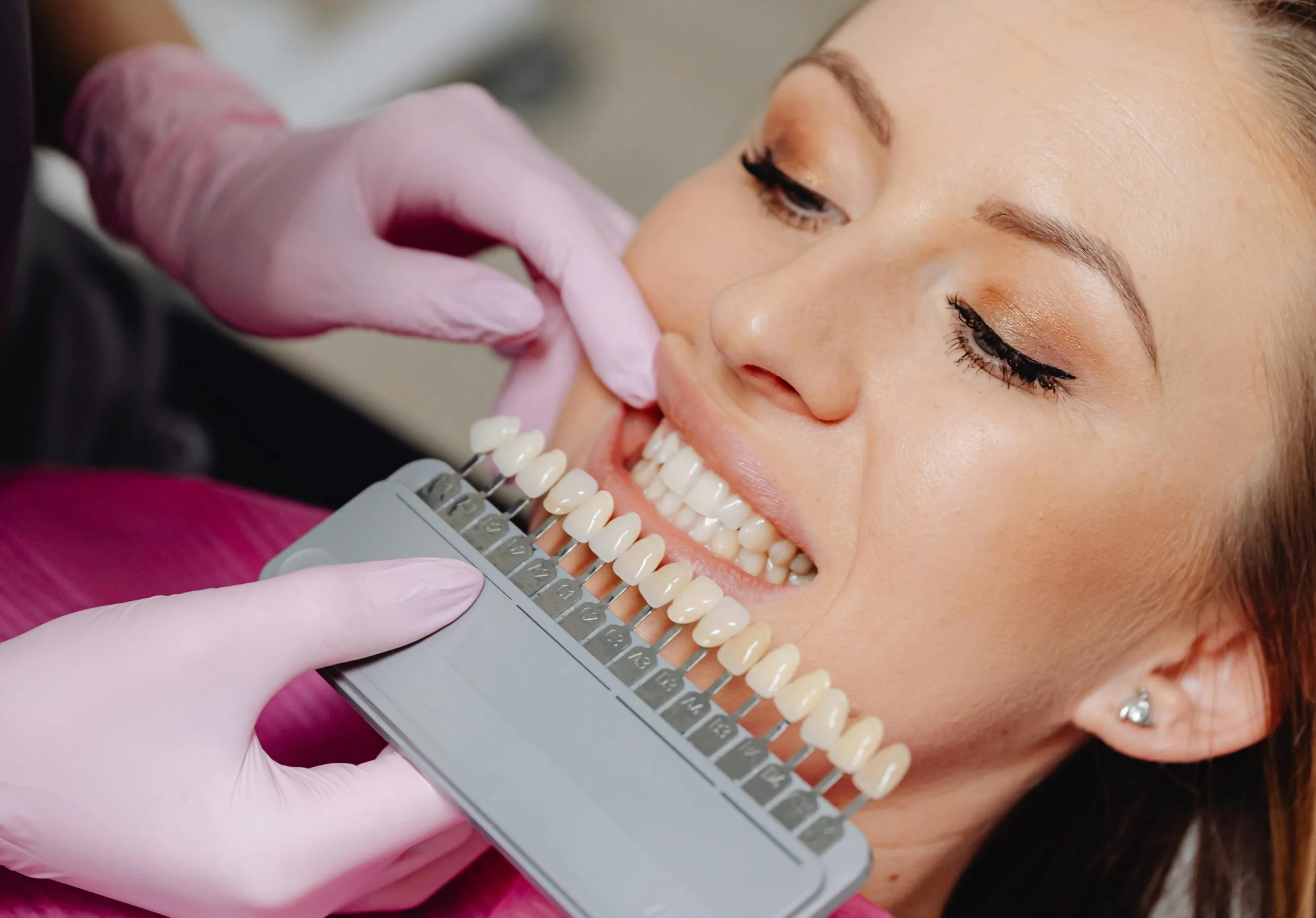 Blanqueamiento Dental: Todo lo que Necesitas Saber Antes de Hacerlo