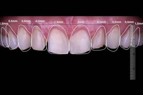 ¿Cómo funciona el Diseño de Sonrisa?