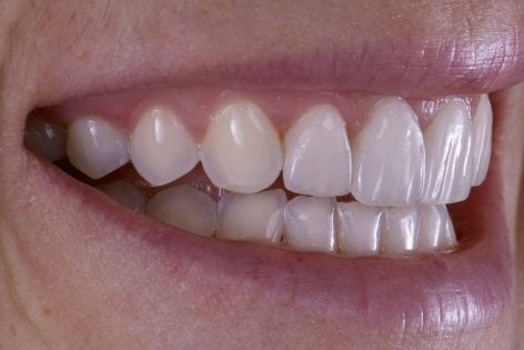 Mitos y Verdades sobre las Carillas Dentales